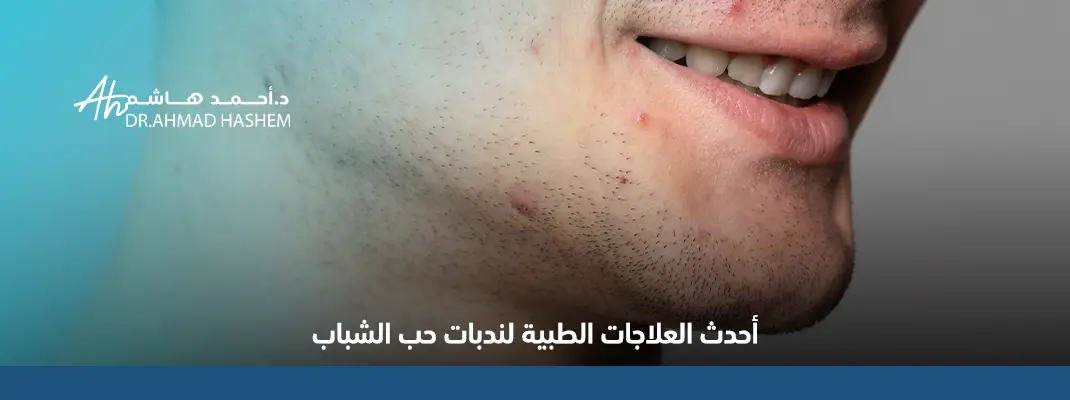 أحدث-العلاجات-الطبية-لندبات-حب-الشباب.webp