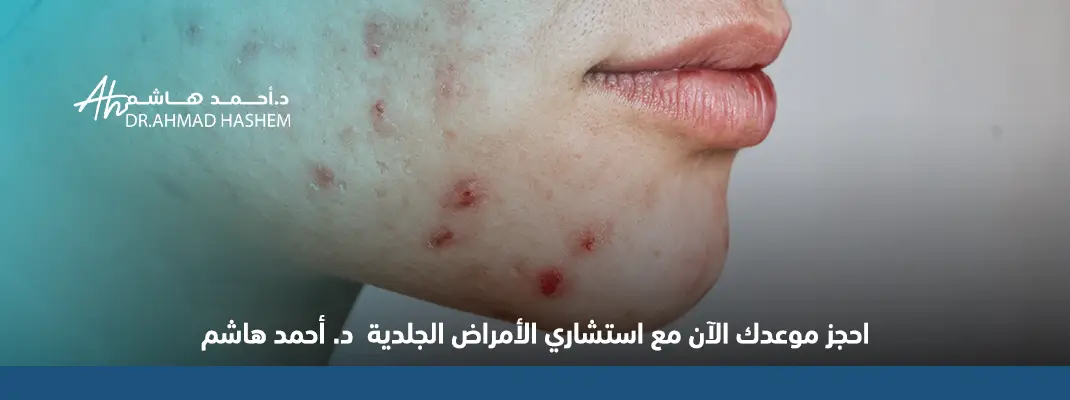 علاج ندبات حب الشباب