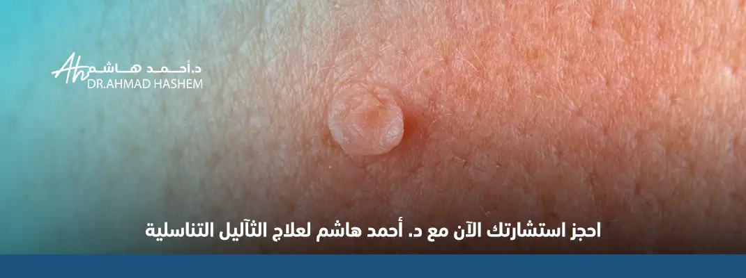 الثآليل التناسلية​