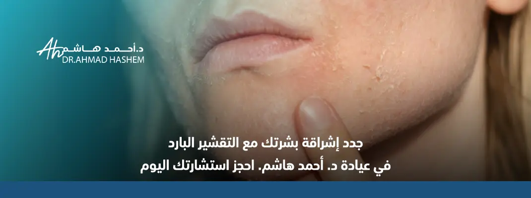  التقشير البارد للوجه