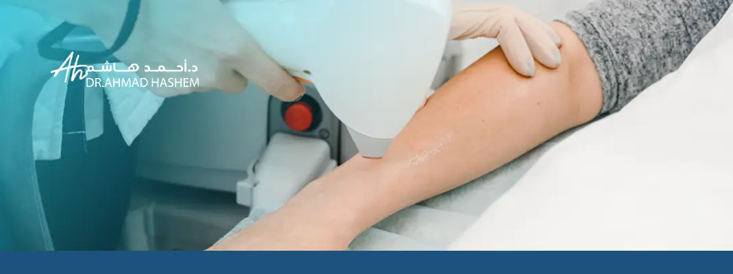 ليزر إزالة الشعر