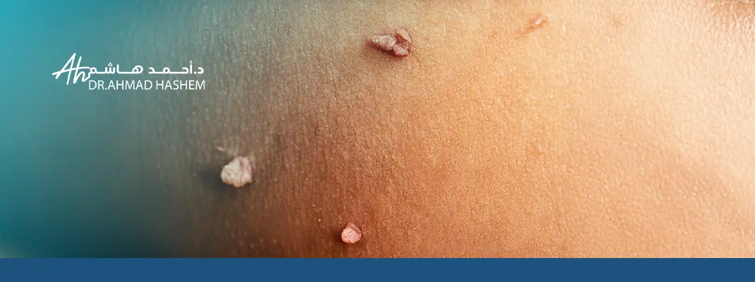 الثآليل التناسلية​