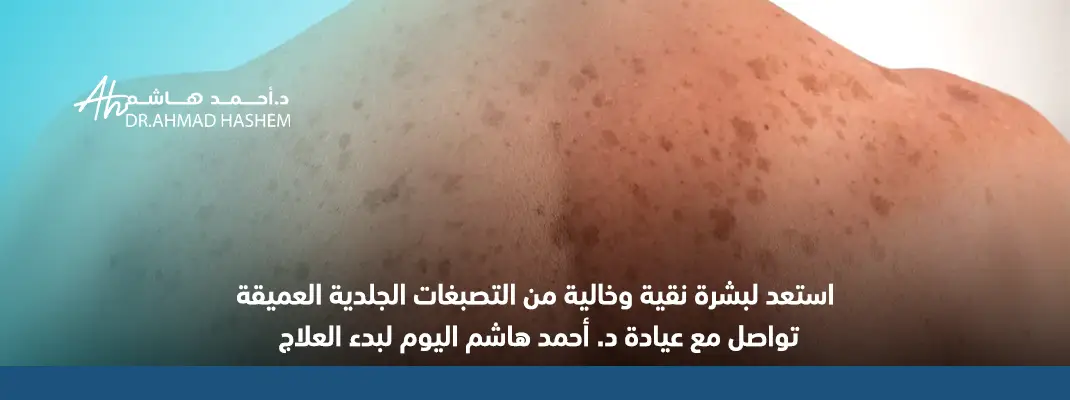 علاج التصبغات الجلدية العميقة​