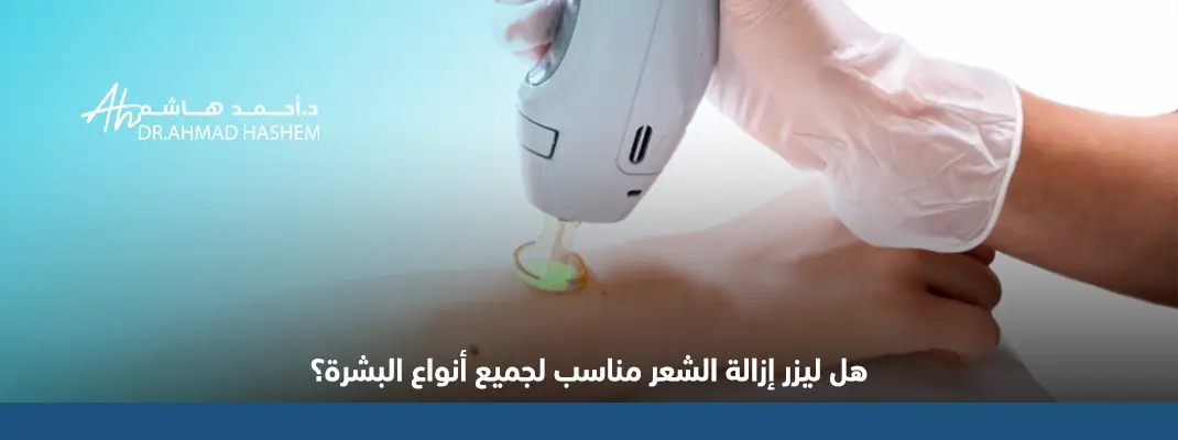 ليزر إزالة الشعر