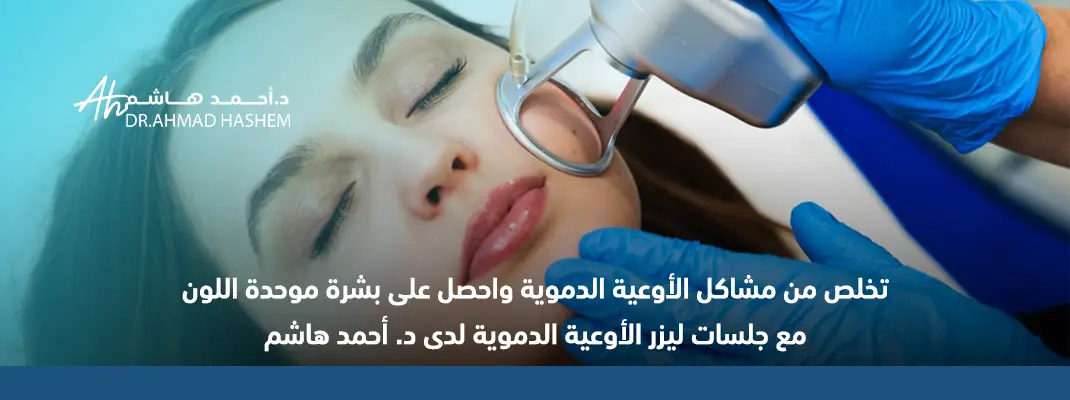 ليزر الأوعية الدموية