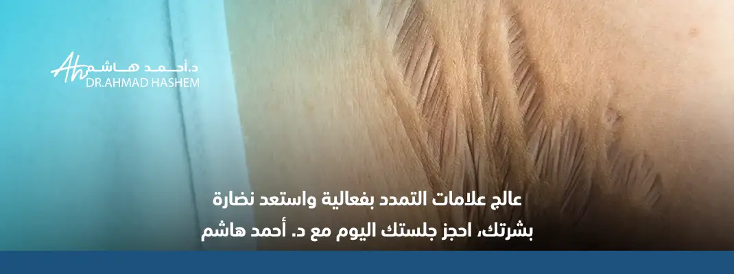 ما هو دور الفيلر في علاج علامات التمدد الحمراء والبيضاء ما هو دور الفيلر في علاج علامات التمدد الحمراء والبيضاء