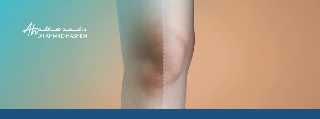 تفتيح الركب​ ،تبييض الركب​