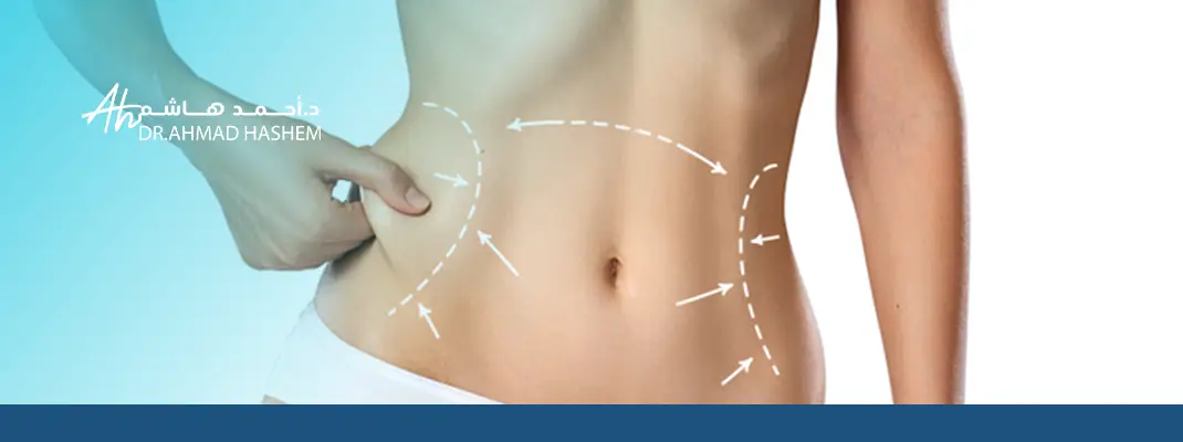 شد ترهلات البطن