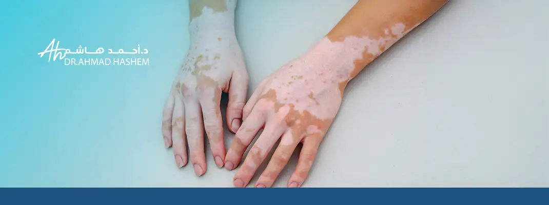 أسباب البهاق،أسباب البهاق البني 