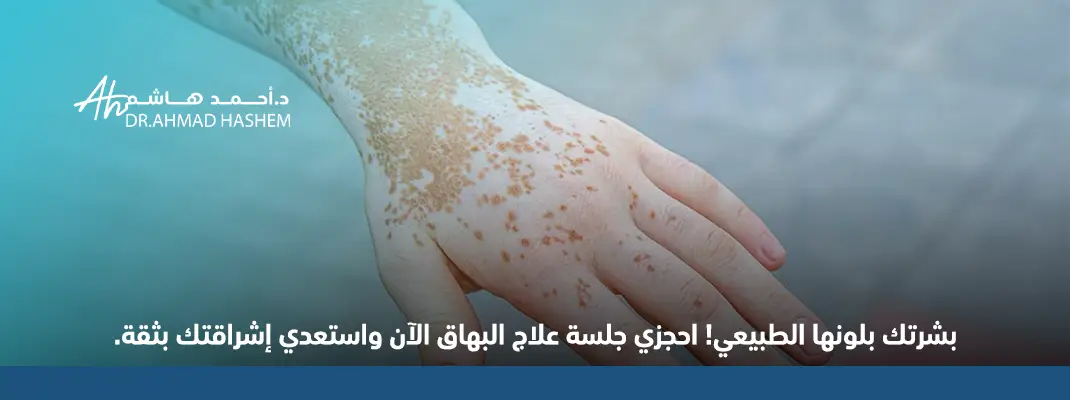 أفضل دكتور في علاج البهاق،اسرع طريقة لعلاج البهاق