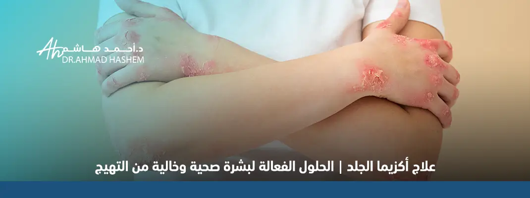 علاج أكزيما الجلد