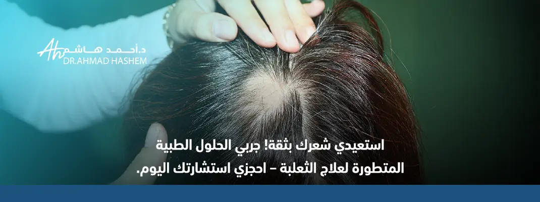 علاج الثعلب،ابر علاج الثعلبة