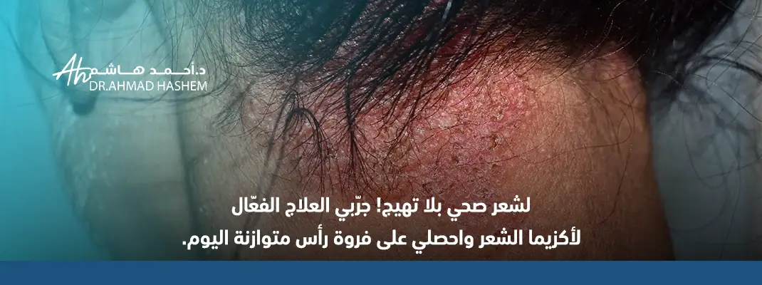 اكزيما فروة الرأس