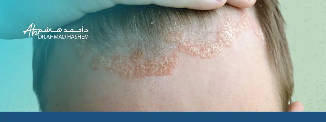 اكزيما فروة الرأس