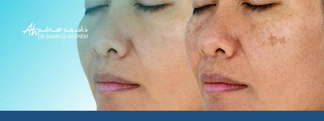 Deep skin pigmentation treatment