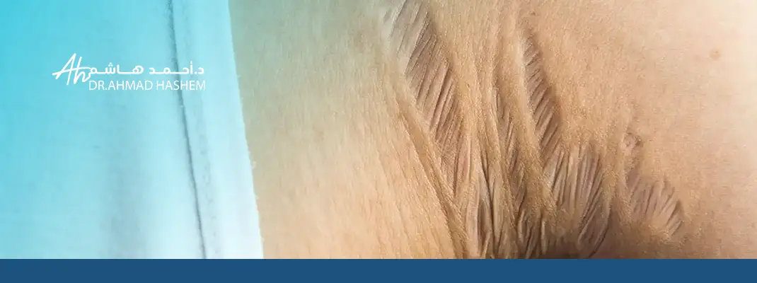 Stretch Marks Treatment