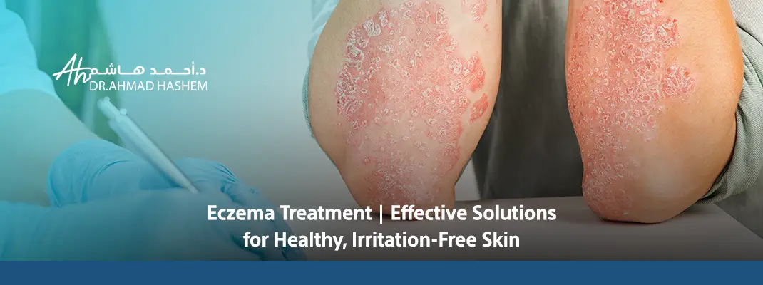 Eczema-Treatment-Effective-Solutions-for-Healthy-Irritation-Free-Skin-01.webp