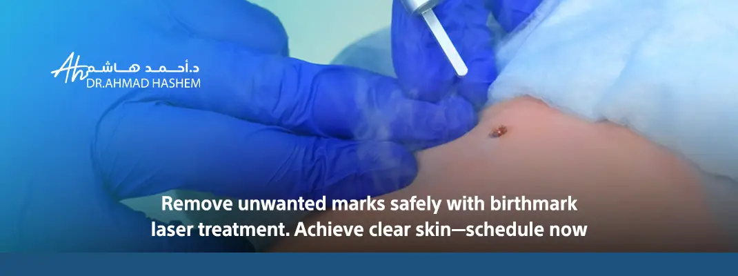 Birthmark Laser