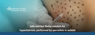 botox for excessive sweating​