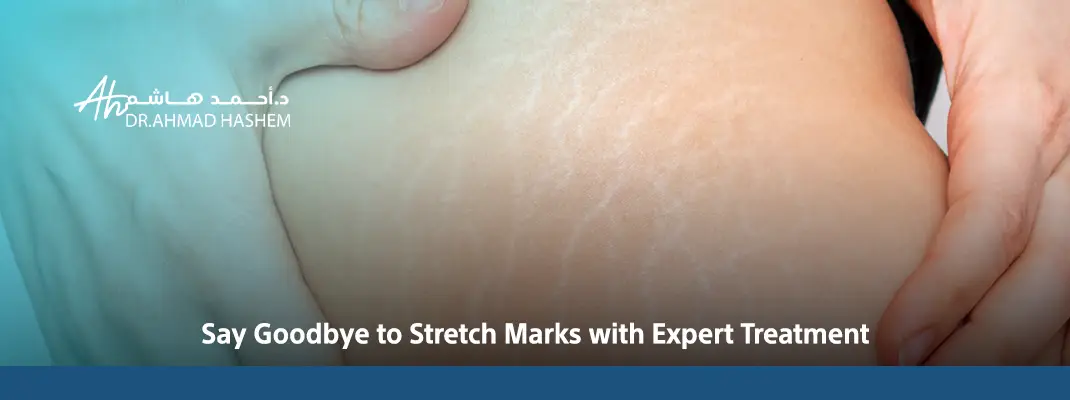 Say-Goodbye-to-Stretch-Marks-with-Expert-Treatment.webp