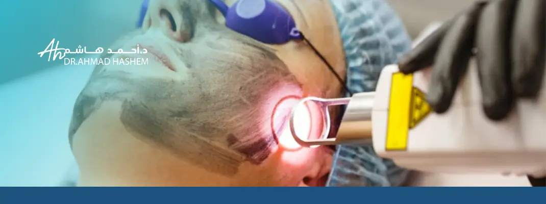 ليزر كربوني للوجه