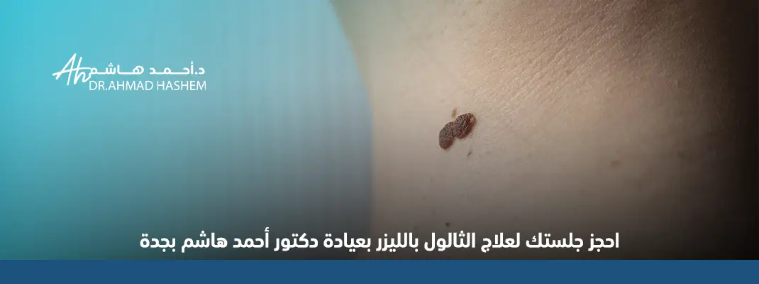 ازالة الثالول​