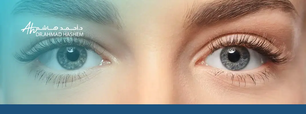 جراحة الجفون التجميلية