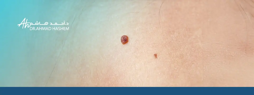 طريقة إزالة الثالول​