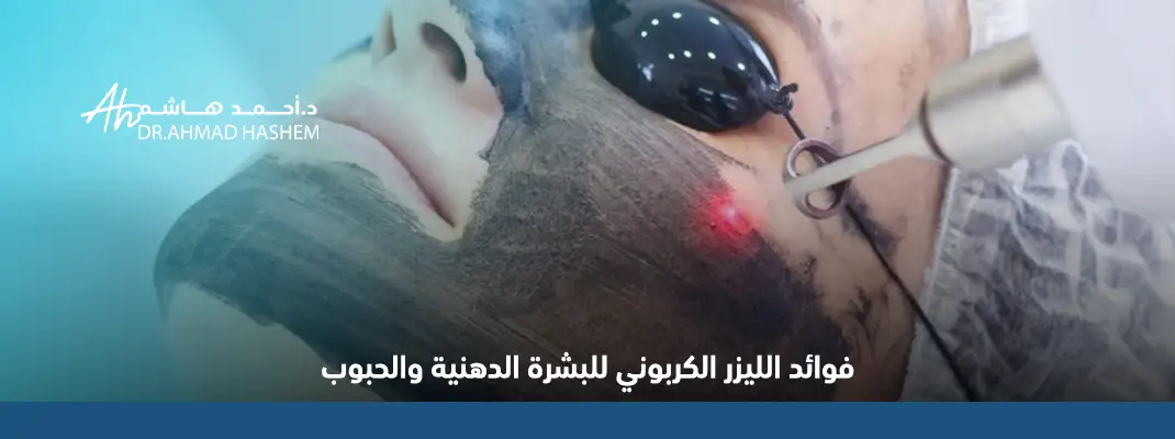 ليزر كربوني للوجه