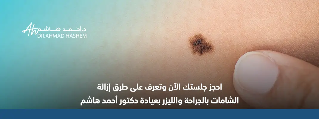 طرق إزالة الشامات بالجراحة والليزر