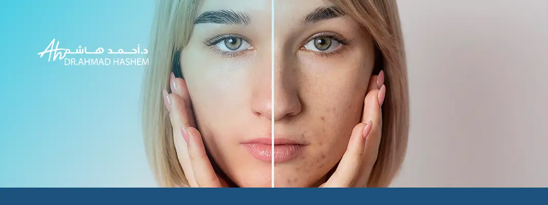 تخلص من آثار الحبوب والجروح مع أفضل حلول علاج الندبات 2