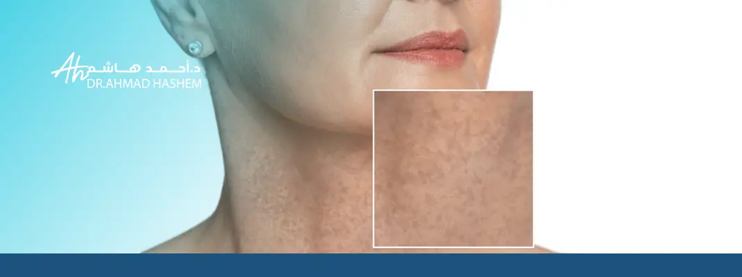 تفتيح الرقبة بالليزر