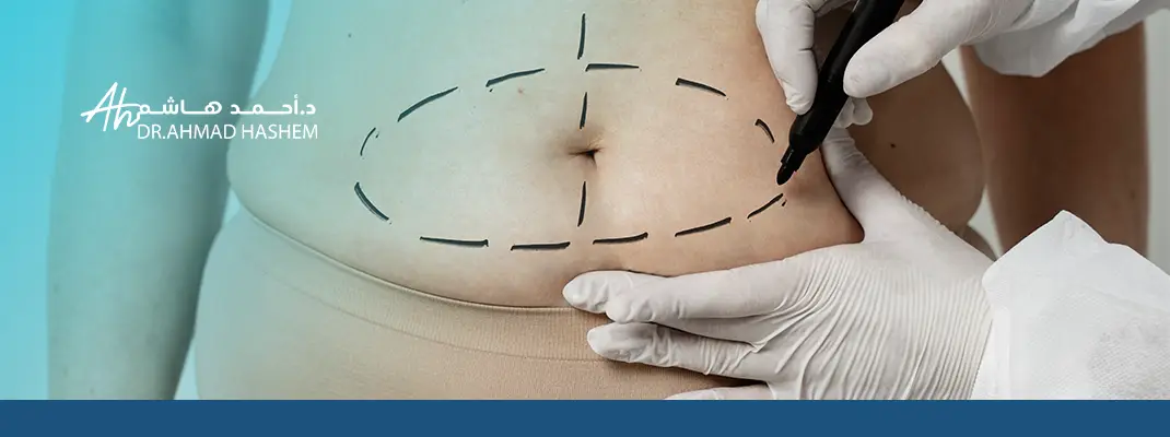 شد ترهلات البطن