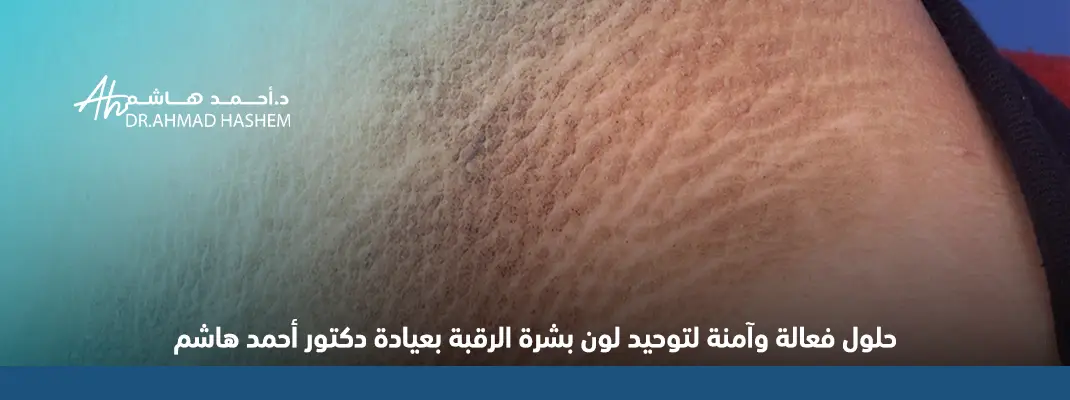 علاج سواد الرقبة