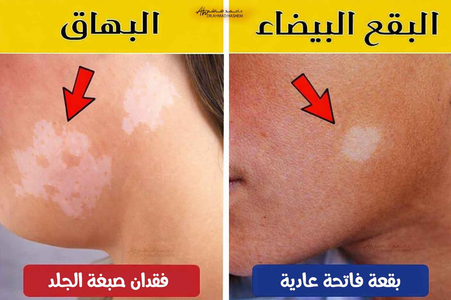 الفرق بين البقع البيضاء والبهاق