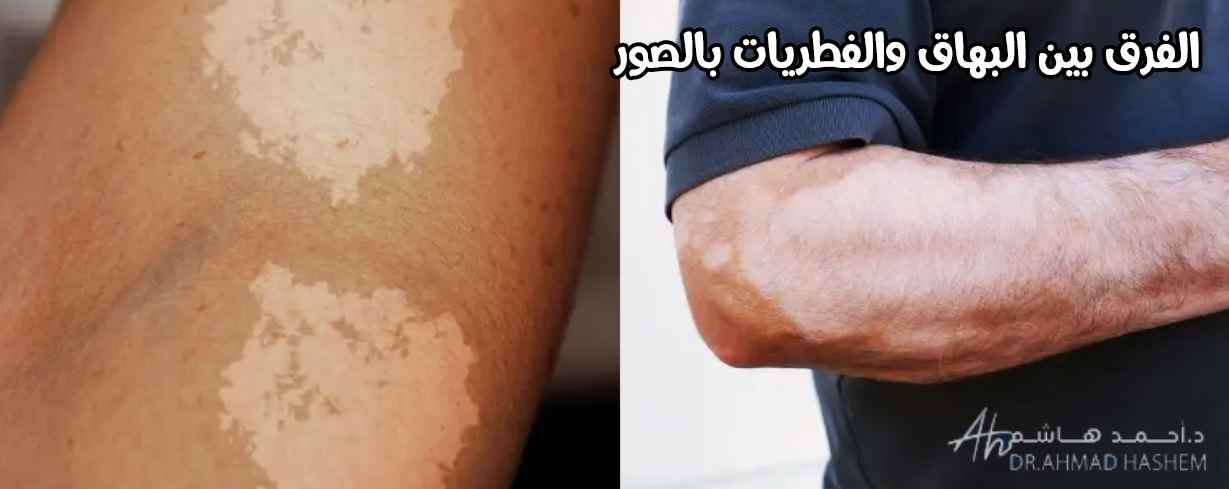 الفرق بين البهاق والفطريات بالصور