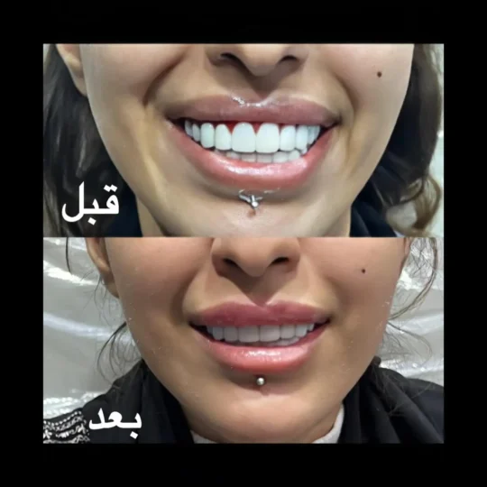 بوتكس الابتسامة اللثوية قبل وبعد