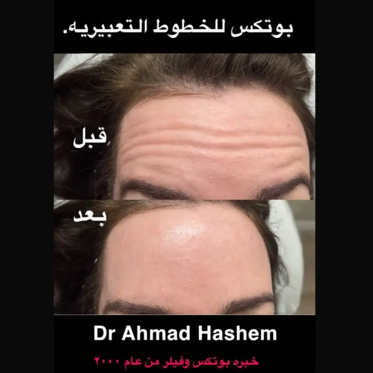 بوتكس خطوط التجاعيد