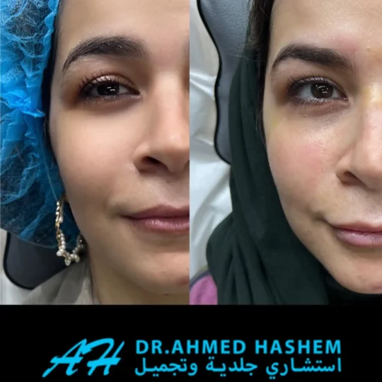 بوتكس رفع الحواجب قبل وبعد 2