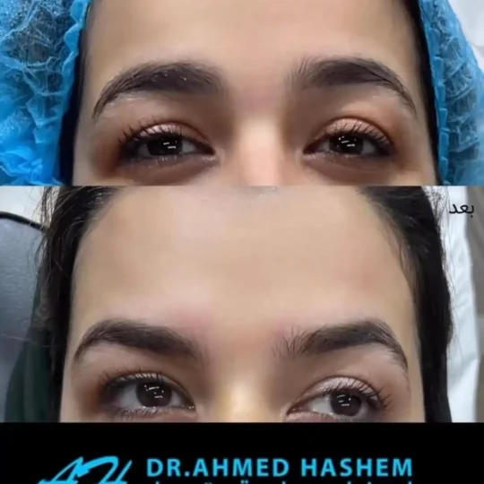 بوتكس رفع الحواجب قبل وبعد