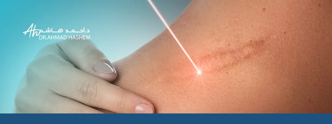 تجربتي مع الليزر للندبات