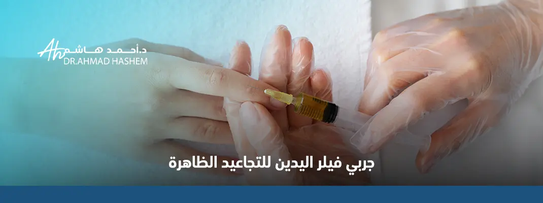 تجربتي مع فيلر اليدين