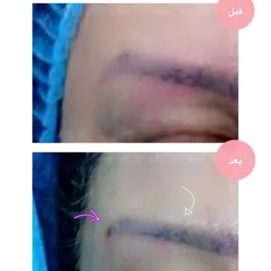 شد ورفع الحواجب بالخيوط