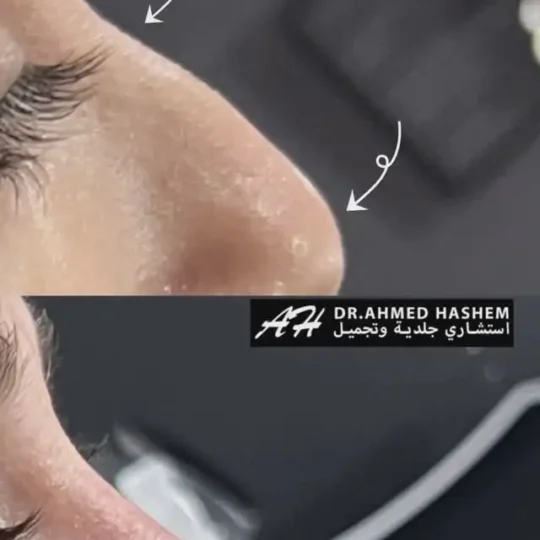 فيلر الأنف قبل وبعد 2