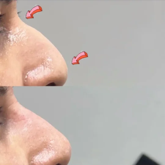 فيلر الأنف قبل وبعد 1