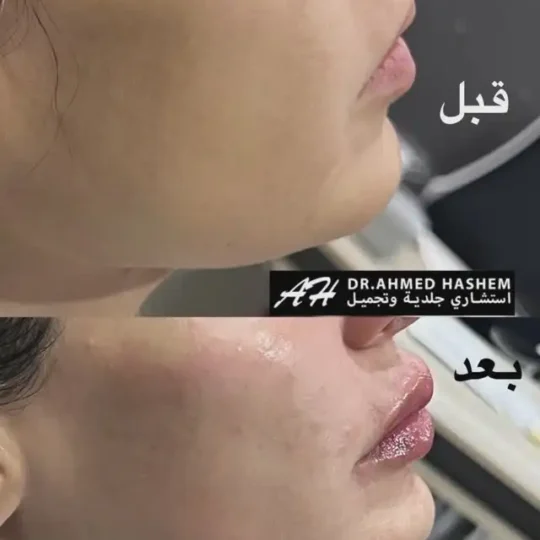 فيلر الأنف والشفايف والفك