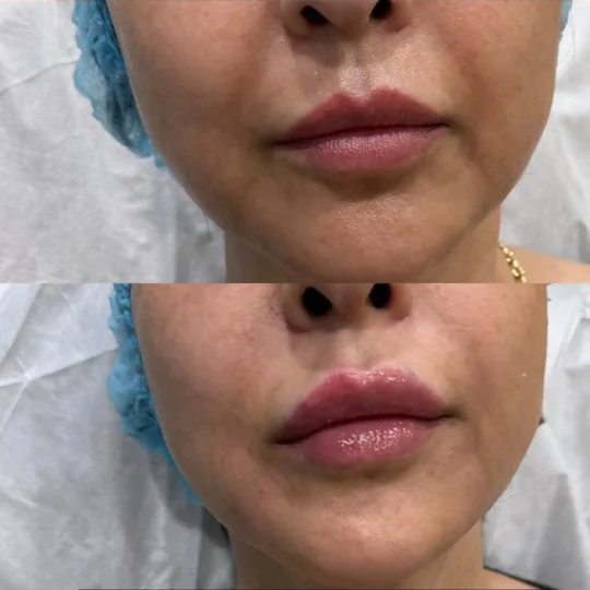 فيلر الشفايف قبل وبعد 2