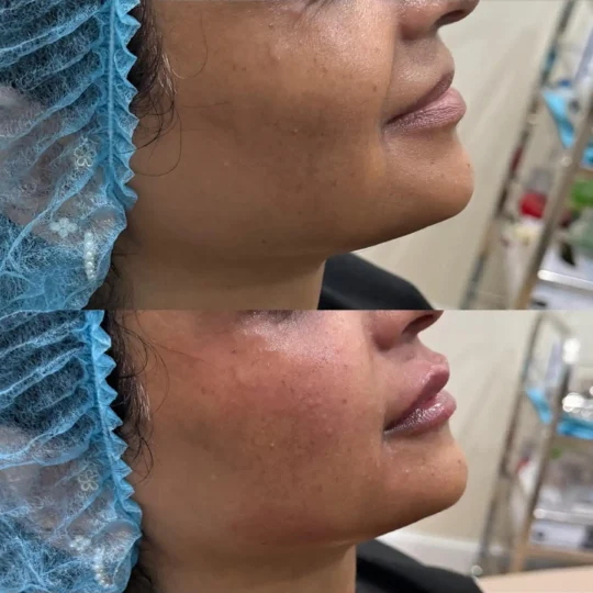 فيلر الشفايف قبل وبعد 3