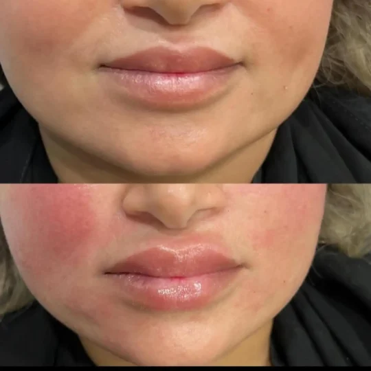 فيلر الشفايف قبل وبعد 4