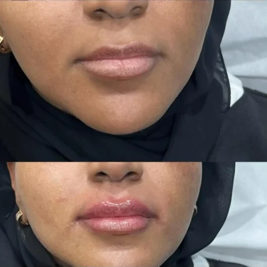 فيلر الشفايف قبل وبعد 5